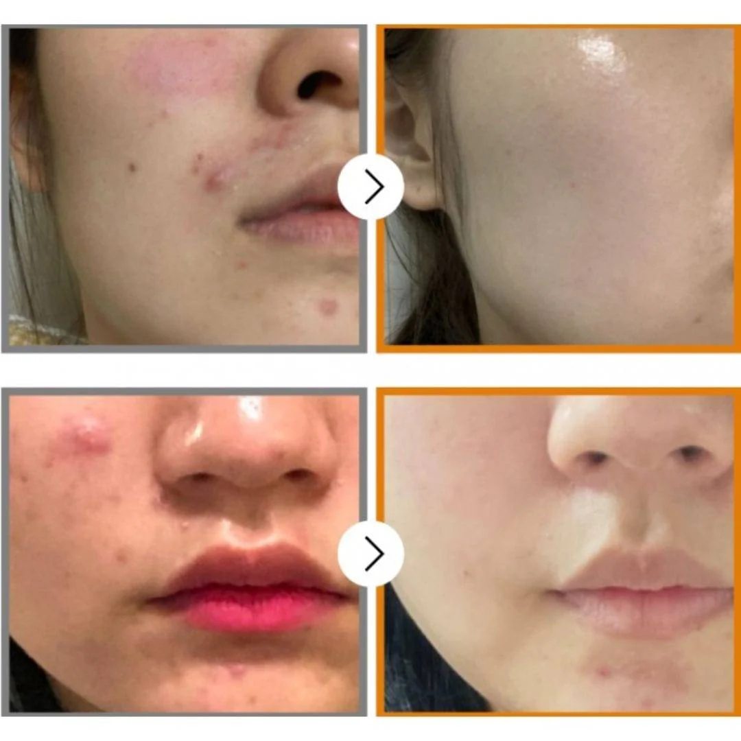 Numbuzin No.5 Goodbye Blemish Serum - Image 6